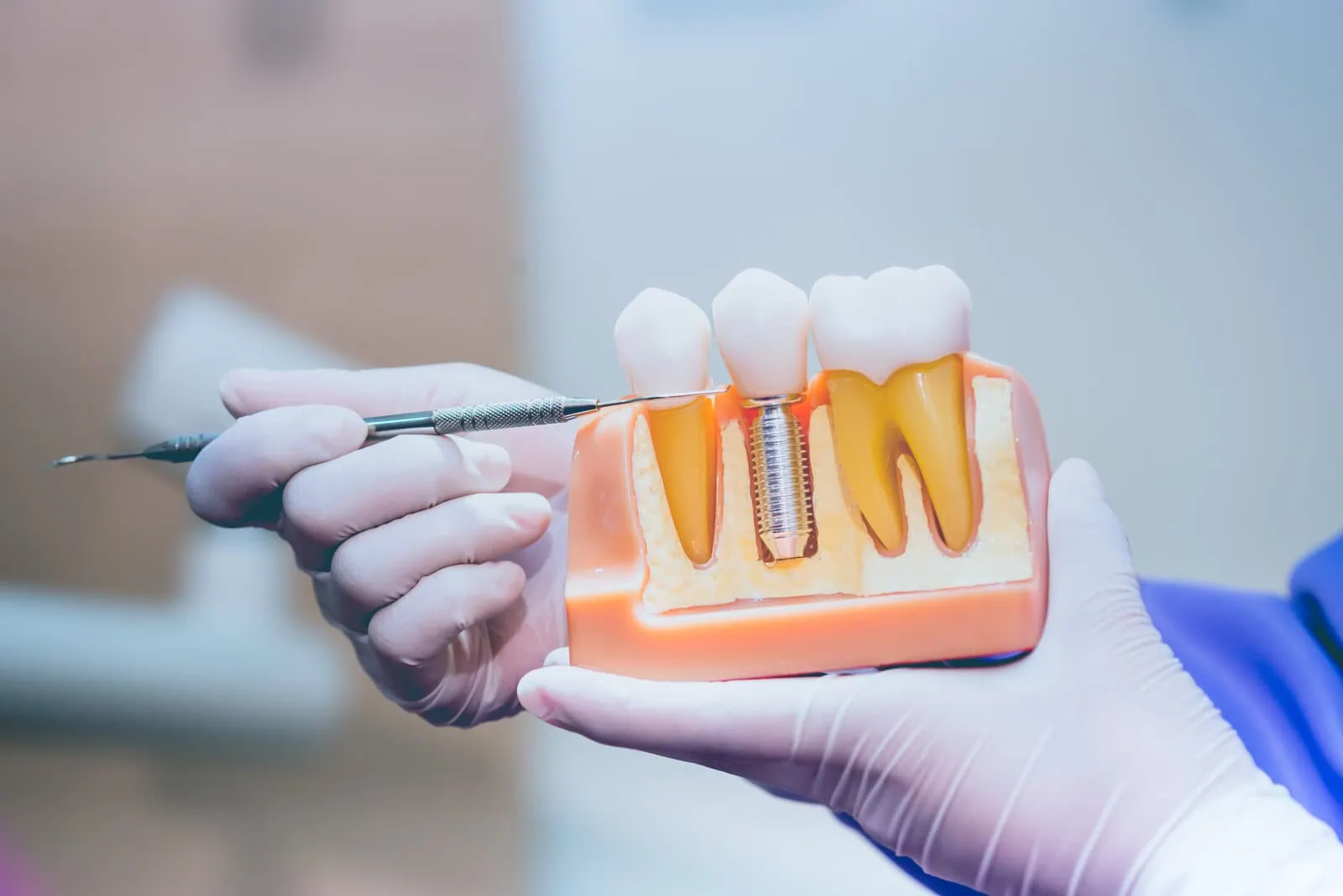 CEREC chairside design software in use
